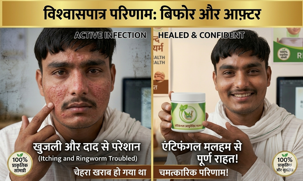 KGN AYURVEDA antifungal Ayurvedic Kit